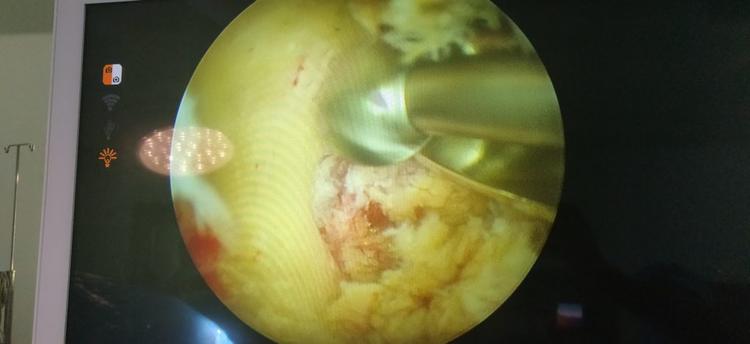 Endoscopic Spine Surgery Image 1