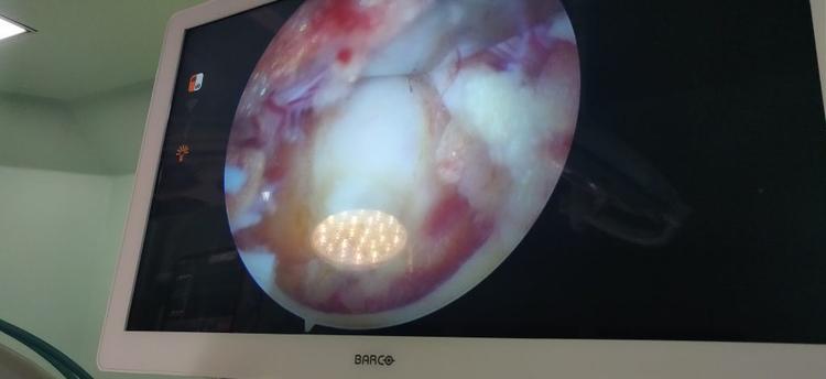 Endoscopic Spine Surgery Image 3