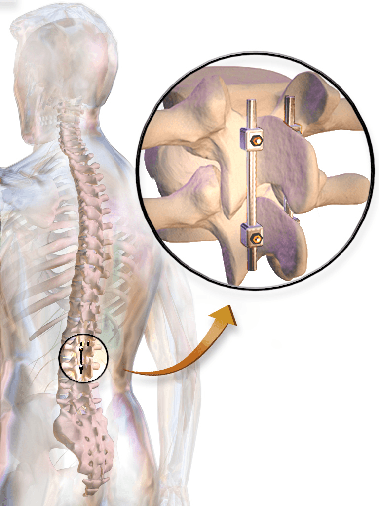 Geriatric Spine Surgery