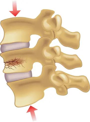 Traumatic Conditions of Spine